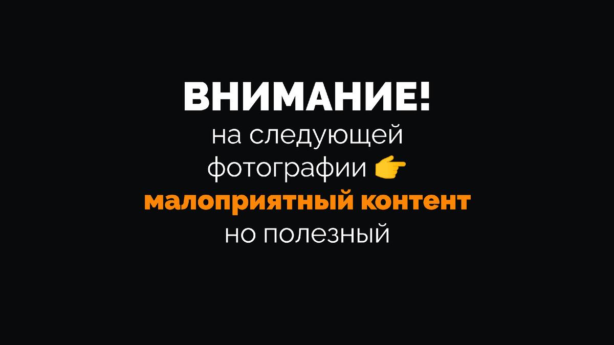 Что делать, когда кости не осталось совсем? Жизнеспособна ли идея менять имплантаты каждые 10-15 лет? Из-за чего уходят кость и десна и оголяются имплантаты?-8